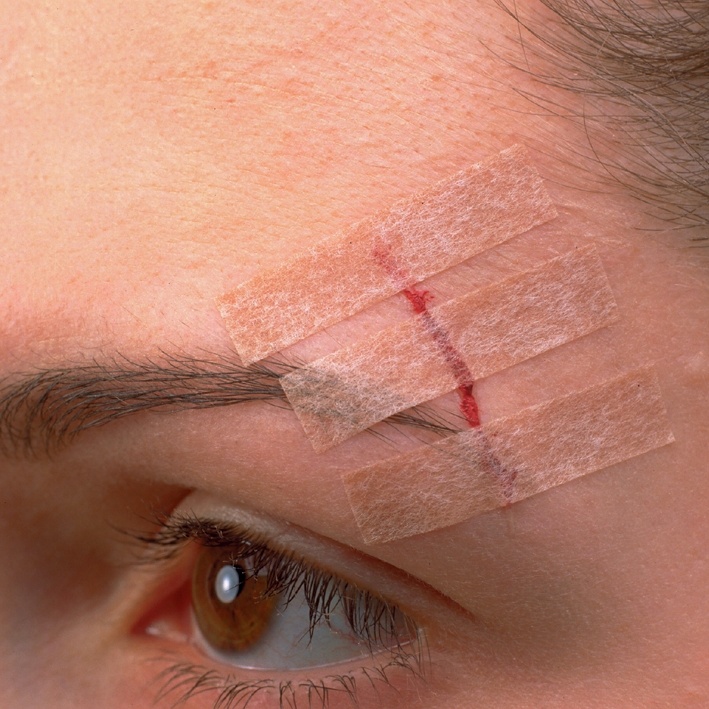 Steri-Strip Blendtone Wundverschluss