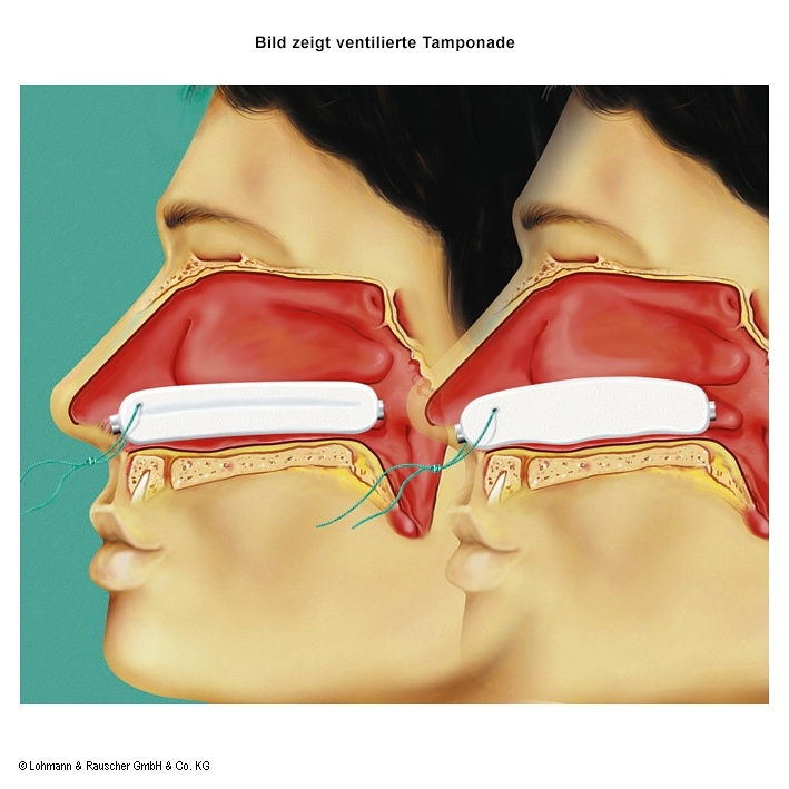 [LOH 147344] Raucocel Nasentamponaden gerade Mit Faden, 80 mm (10 Stck.)