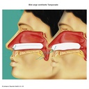 Raucocel Nasentamponaden gerade Mit Faden, 80 mm (10 Stck.)