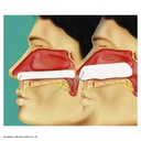 Raucocel-Epistaxistamponaden Steril, 55 mm (10 Stck.)